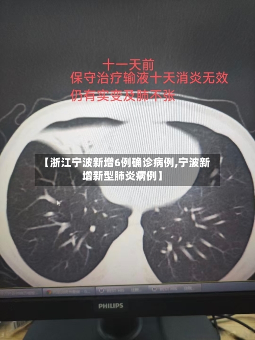 【浙江宁波新增6例确诊病例,宁波新增新型肺炎病例】